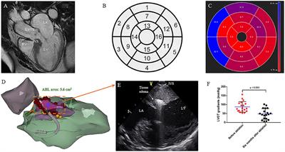 Selective Interventricular Septal Radiofrequency Ablation in Patients With Hypertrophic Obstructive Cardiomyopathy: Who Can Benefit?